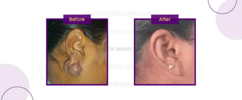 Real Patient Story: Bilateral Ear Keloid Removal Success